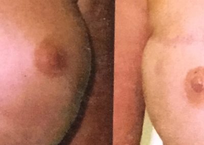 Areola Restoration following Breast Reconstruction surgery