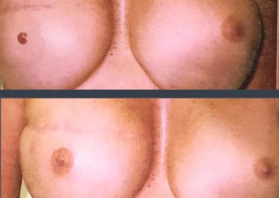 Areola Restoration following Breast Reconstruction surgery